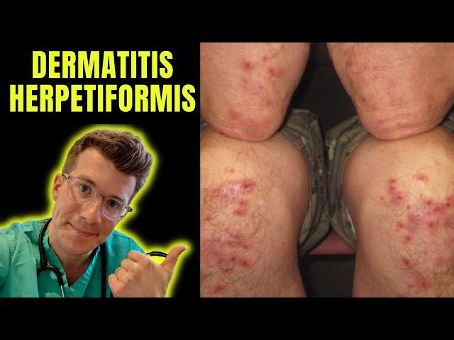 Dermatitis Herpetiformis (rash seen in Coeliac Disease aka gluten intolerance) explained...