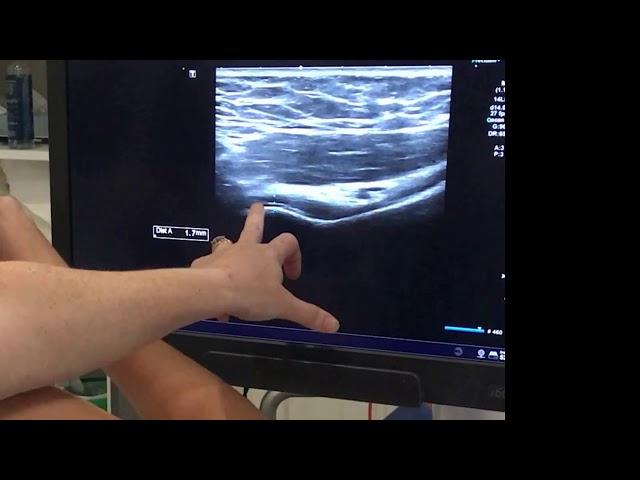 IGHL adhesive capsulitis ultrasound