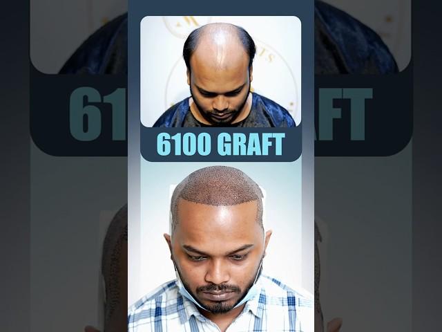 6100 Grafts Hair Transplant in Kolkata #hairtransplant #kolkata #shorts #ytshorts