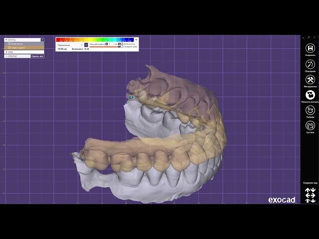 Секреты Exocad - выравнивание сканов