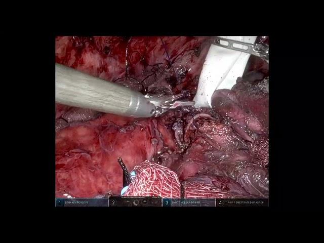 Cerfolio Robotic - Technical Highlights,  Robotic Sleeve LUL with Anastomosis Between LMSB and LLL