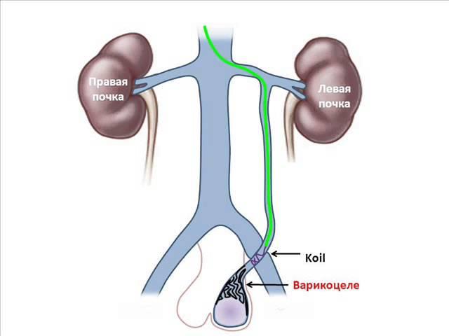 БЕЗОПЕРАЦИОННОЕ ЛЕЧЕНИЕ ВАРИКОЦЕЛЕ С ПОМОЩЬЮ МЕТОДА ЭМБОЛИЗАЦИИ