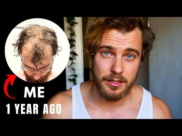 Preventing Balding: What I Did Before It Was Too Late.