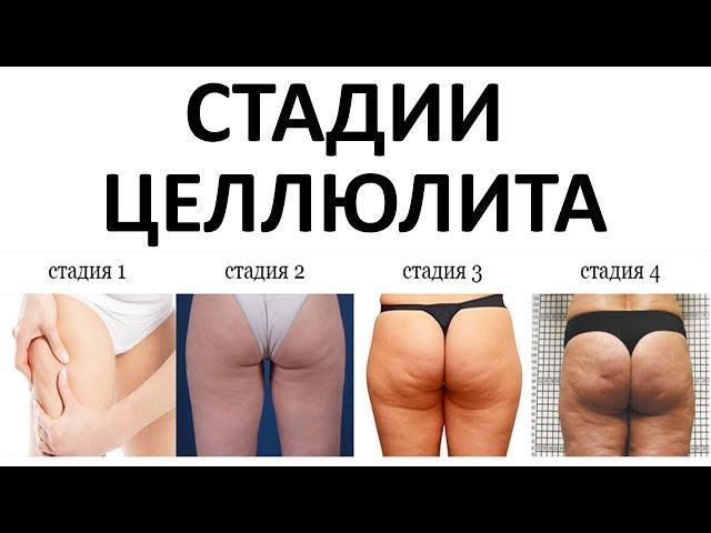 Определяем Вашу Стадию Целлюлита