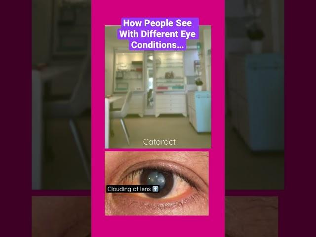 How People See With Different Eye Conditions: #diabetic retinopathy #glaucoma #cataract