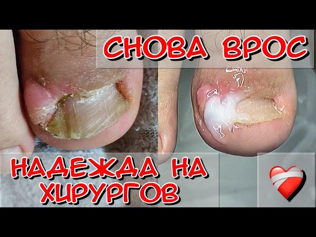 Вросший ноготь / Надежда на хирургов / Педикюр / Подология