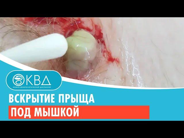 ↪ Вскрытие прыща под мышкой. Клинический случай №808
