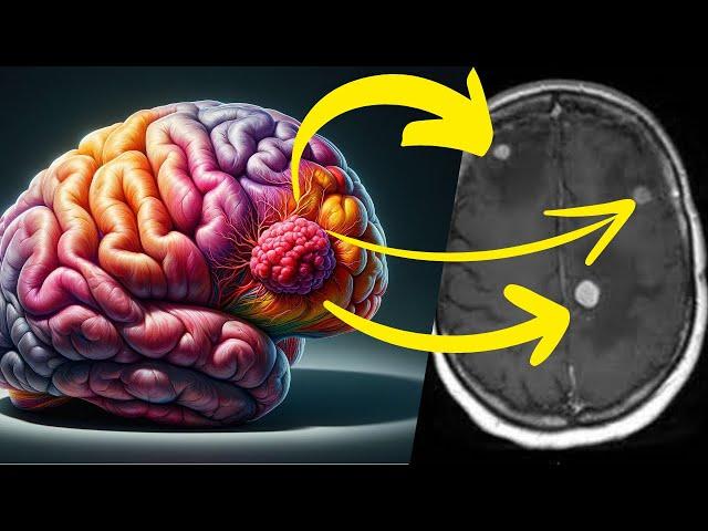 Brain Tumors - A Masterclass in Medicine For Metastatic Cancer In The Brain