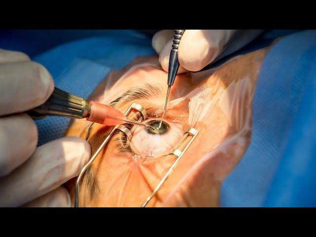 Unhappy Multifocal Patient: Intraocular Lens Exchange after Cataract Surgery