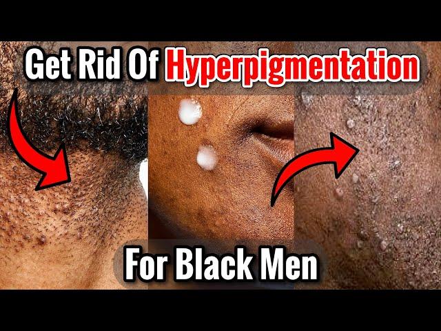 How to Get Rid of Hyperpigmentation From Shaving for Black Men