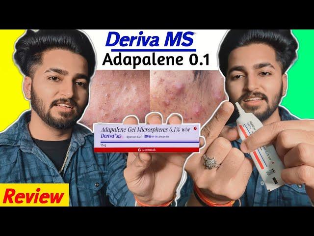 Blackheads, Acne Removal Adapalene Gel | Deriva MS Gel Review