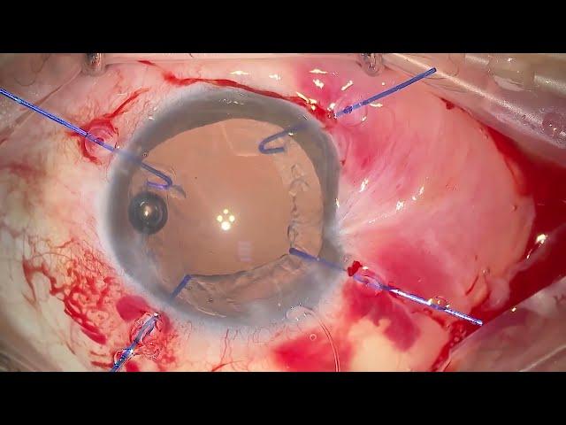 Telegin Technique (Traumatic Zonular Dialysis and Cataract)