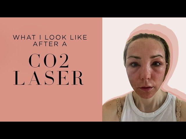 My CO2 Laser Experience: Post-Treatment Transformation and Recovery Tips by an Expert Dermatologist