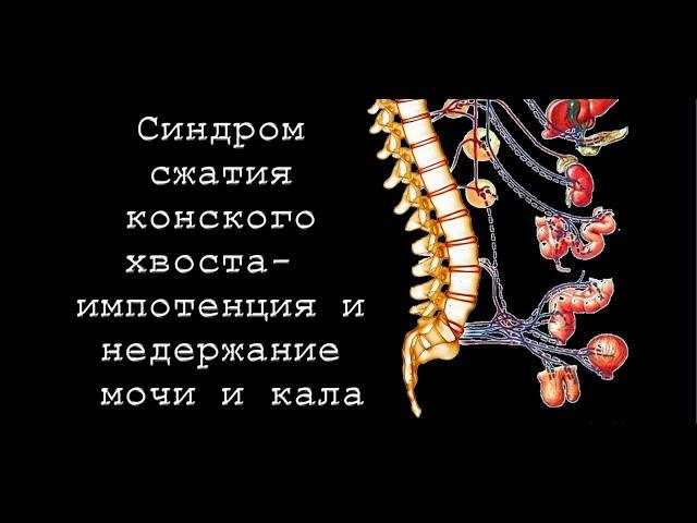 Синдром сжатия конского хвоста-  импотенция и недержание мочи и кала