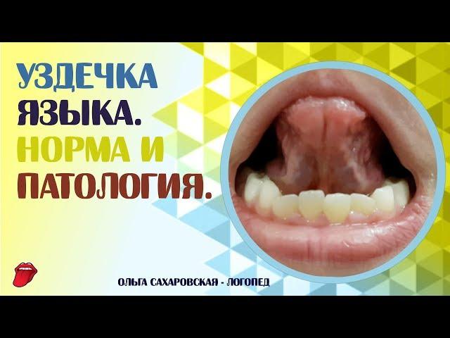 Как определить длину уздечки? Короткая уздечка языка и норма