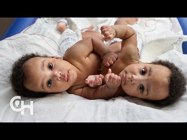 Conjoined Twins Separation: Journey for Amari and Javar