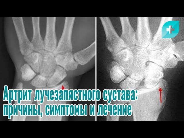 Артрит лучезапястного сустава:причины, симптомы и лечение