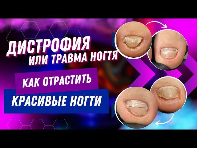 ДИСТРОФИЯ или травма ногтя / Как отрастить красивые ногти? / дистрофия / ногти #педикюр #гельлак