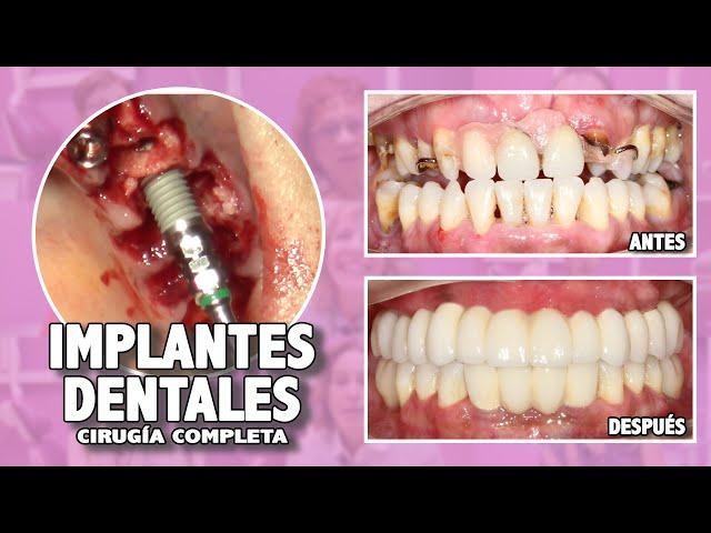 Implantes dentales - Formación en Implantología -