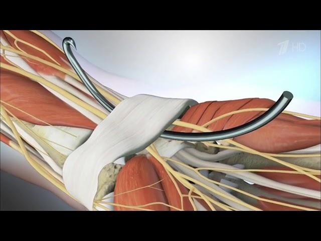 Синдром карпального канала. Схема миниинвазивной операции без разрезов.