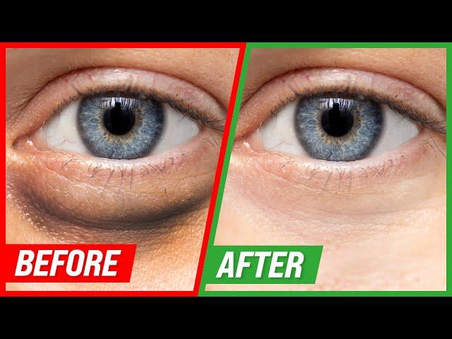 How to Get Rid of Puffy Eyes and Dark Circles