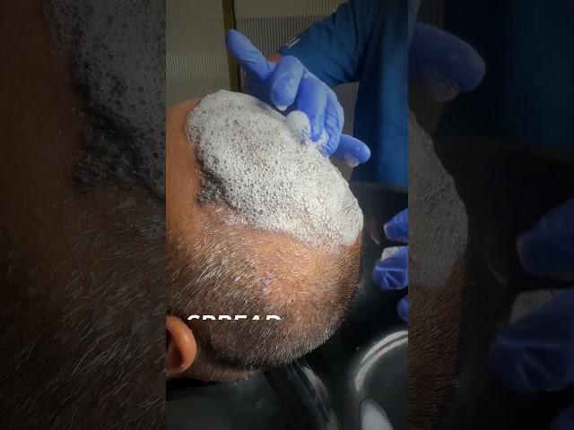 1st Head Wash After 10 Days of Hair Transplant | Post Care