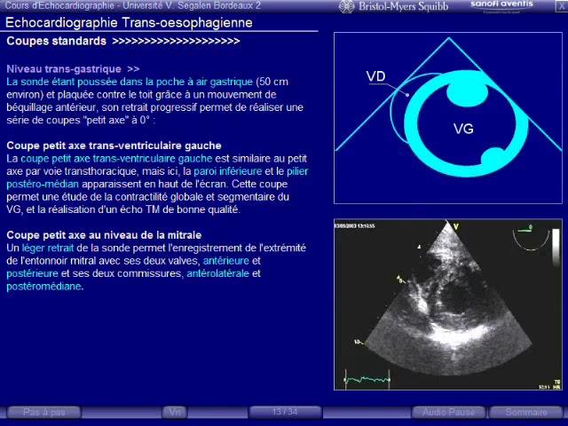 échographie transoesophagienne