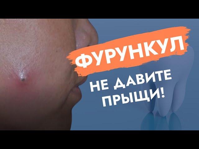 Чирей (фурункул). Не давите прыщи!