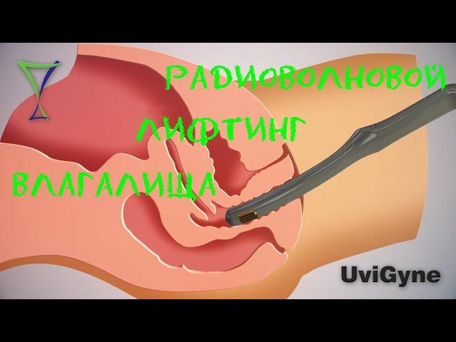 Радиоволновой RF лифтинг влагалища: эффективная процедура омоложения в гинекологии