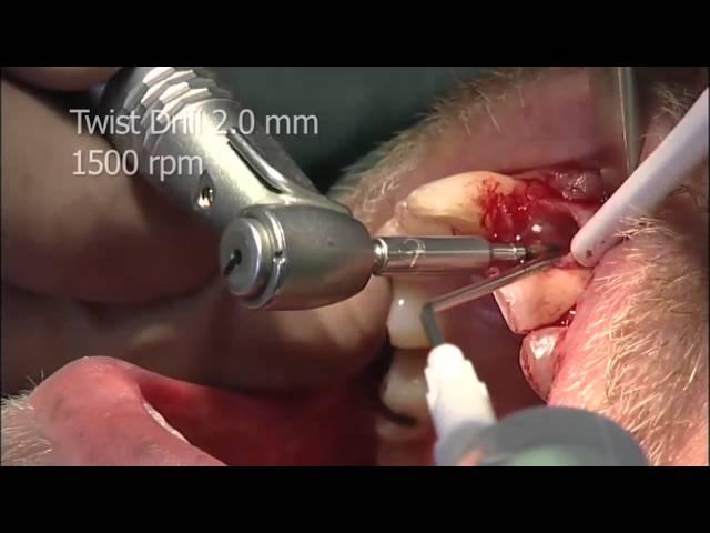 Astra Tech Implant System - Drilling