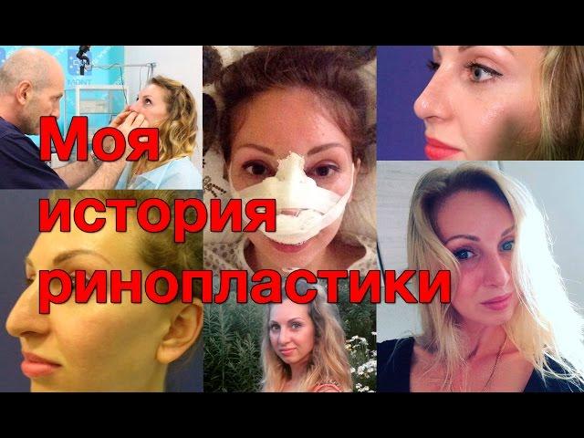 Моя история ринопластики, др. Тимур Кобулашвили
