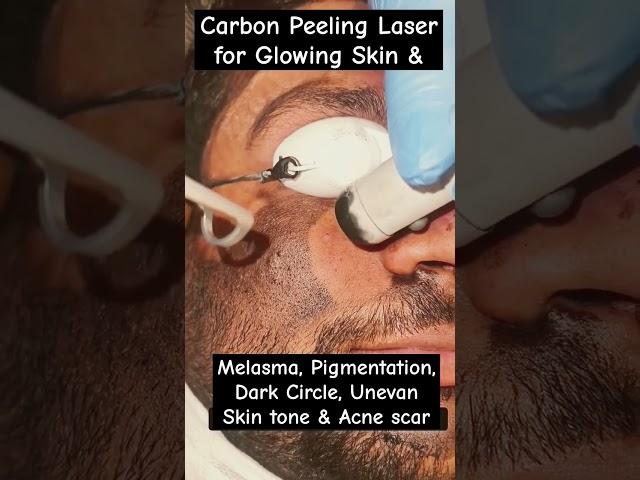 Carbon Peeling Laser Treatment #Beautytips #lasertreatment #skincare