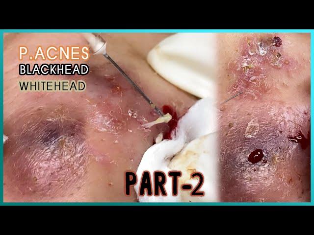 Big Cystic Acne Blackheads Extraction Blackheads & Milia, Whiteheads Removal Pimple Popping