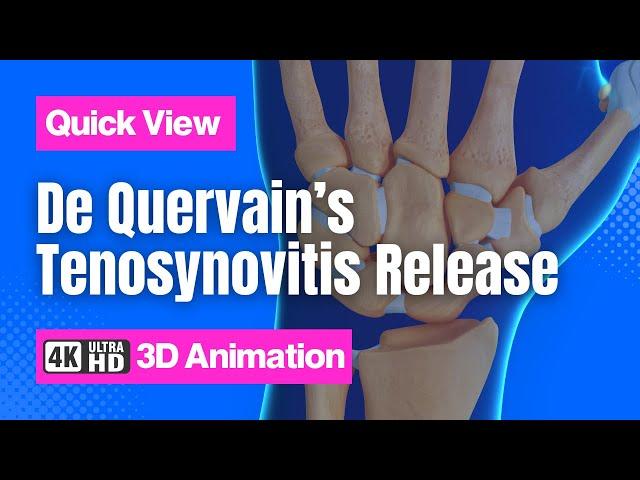 De Quervain’s Tenosynovitis Release // See How It Works // 3D Animation