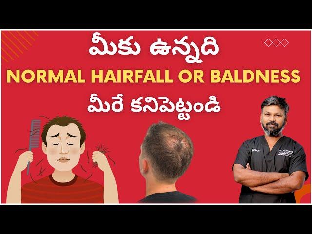 #AskDrJohnWatts | మీకు ఉన్నది Normal Hairfall or Baldness మీరే కనిపెట్టండి |Hair Specialist Explains