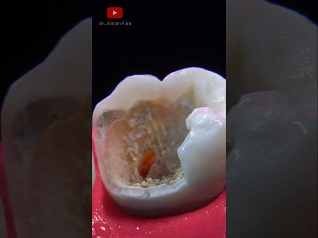 Dental Restoration #asmr #dentist