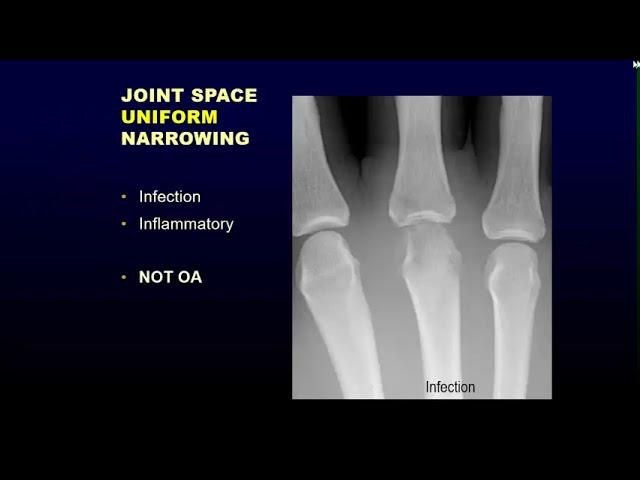 Arthritis I - Erosive arthritis