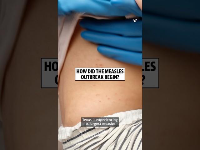 Why is there a measles outbreak in the U.S.?