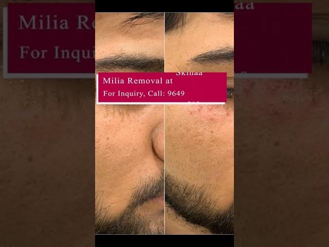 How Much Do You Know about Milia Removal? Milia Removal at Skinaaclinic #milia_removal #miliaremoval