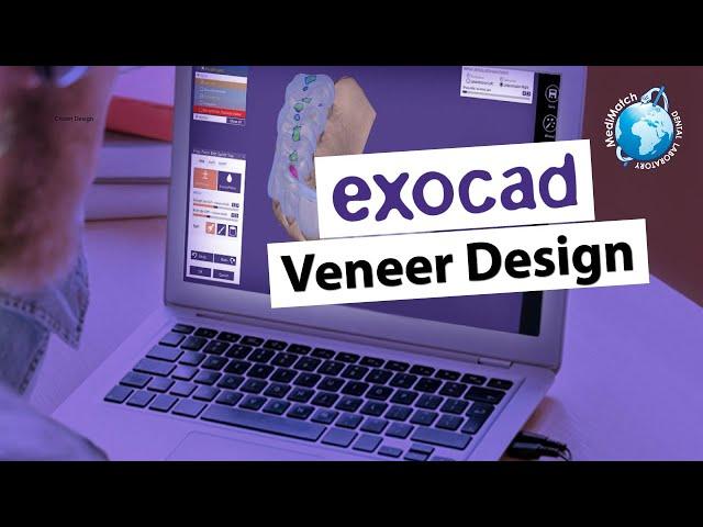 Exocad Veneer Design in minutes