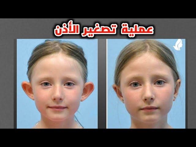 شاهد عملية تصغير الأذن_Ear reduction surgery