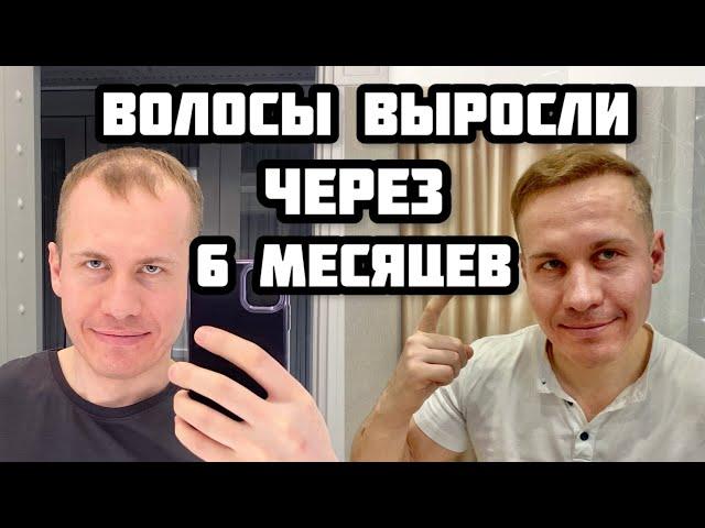 ПЕРЕСАДКА ВОЛОС 6 месяцев. Результаты моей пересадки волос