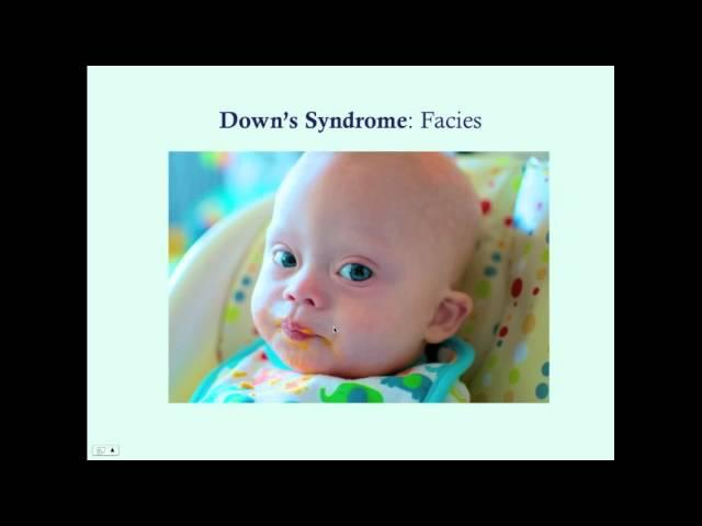 Downs Syndrome - CRASH! Medical Review Series