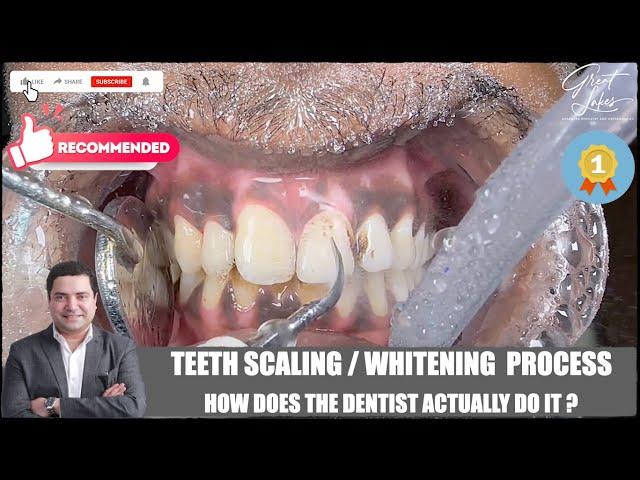 Teeth Scaling Before After | Tartar Removal | Teeth Whitening | Dental Cleaning | Teeth Cleaning