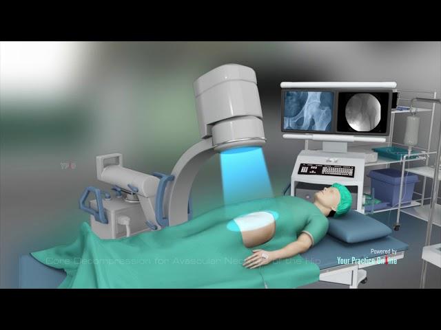 Core Decompression for Avascular necrosis of Hip(AVN)