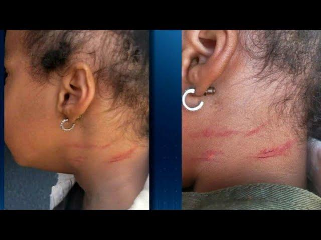 Local grandmother claims granddaughter received scratches at day care | WSB-TV