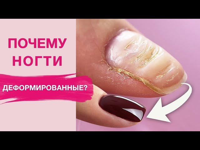 Deformed Nails | How to Fix and Strengthen with Polygel