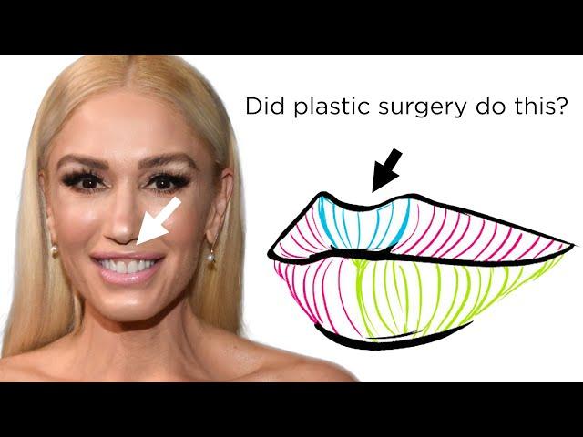 What Happened to Gwen Stefani’s Face? Newport Beach Plastic Surgeon explains