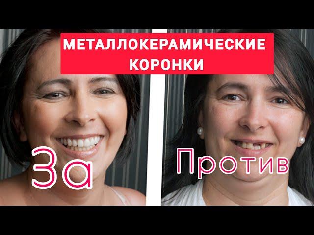 Металлокерамические КОРОНКИ для зубов. МЕТАЛЛОКЕРАМИЧЕСКАЯ коронка на ИМПЛАНТЕ.