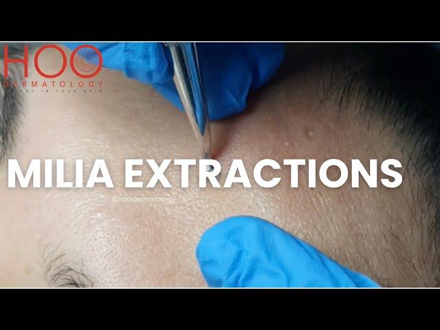 MILIA EXTRACTIONS PART TWO  | MILIA MEDLEY